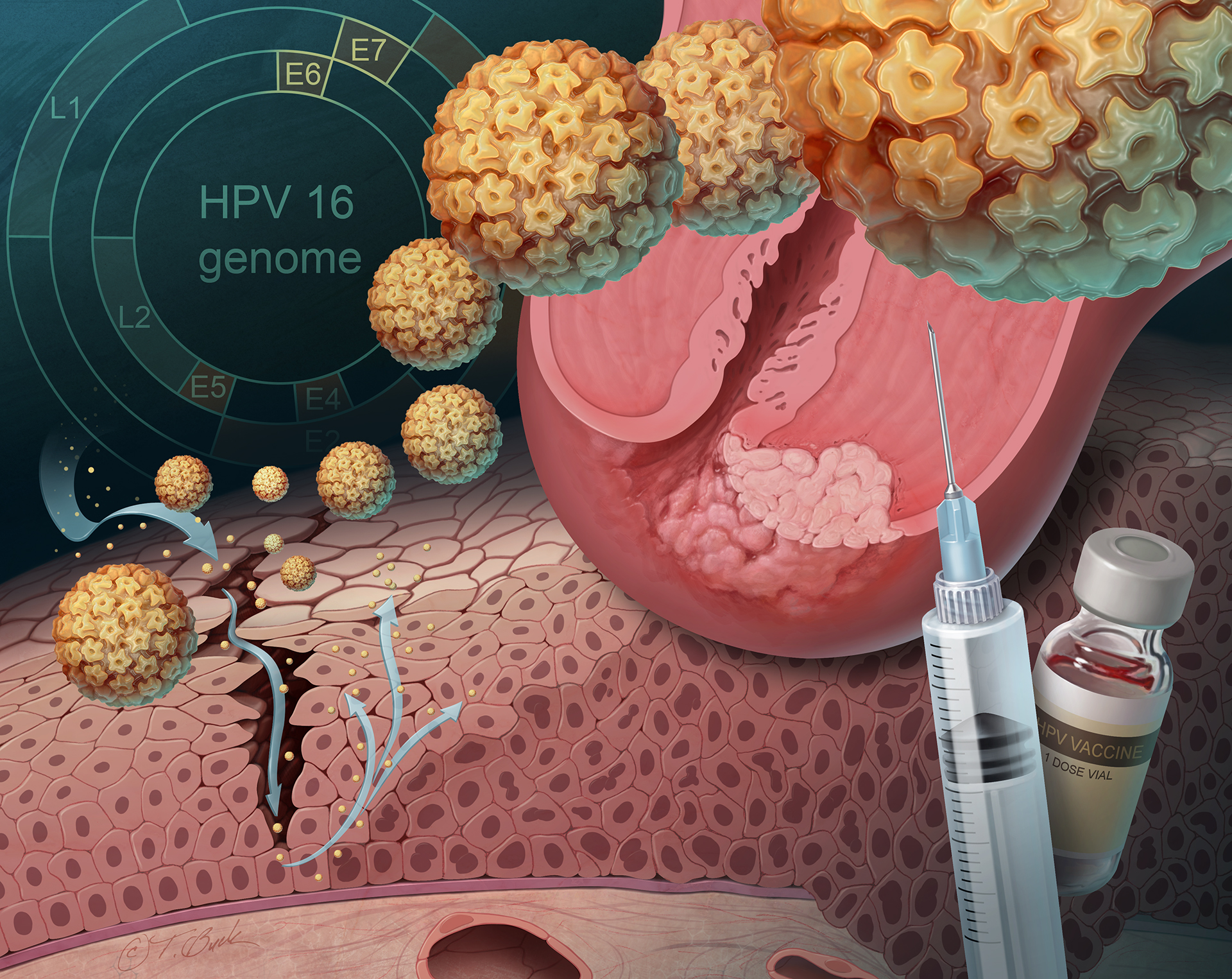 Hpv And Cervical Cancer Todd Buck Illustration