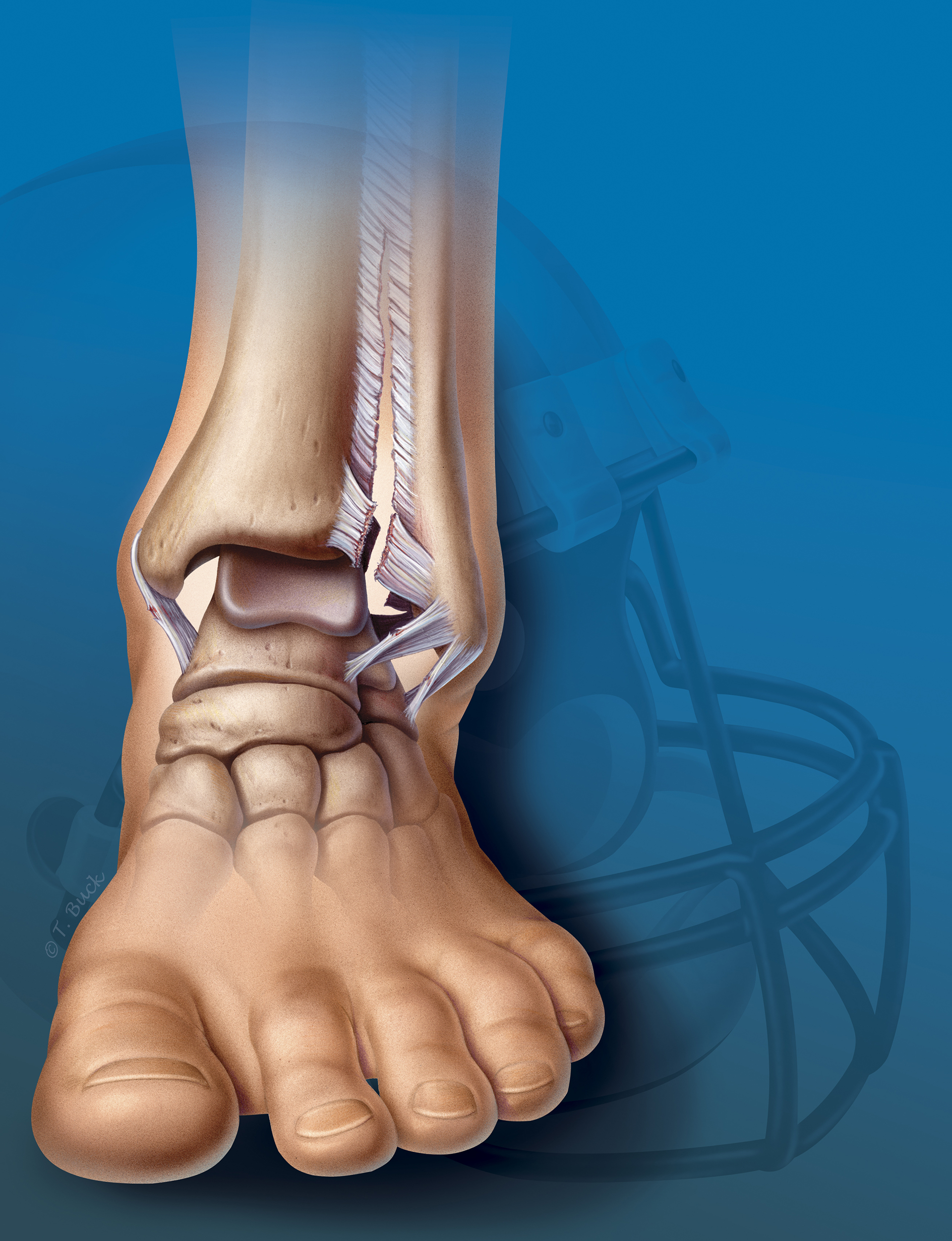 Strained Ligament toddbuck.com>medical-illustration-portfolio